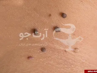 برداشت خال زگیل گوشت اضافی زگیل تناسلی